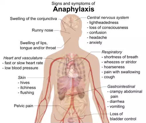 معنی کلمه آنافیلاکسی در فرهنگ عمید
