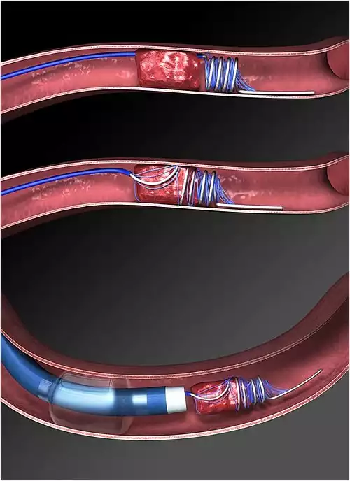 معنی کلمه سکته مغزی در ویکی واژه